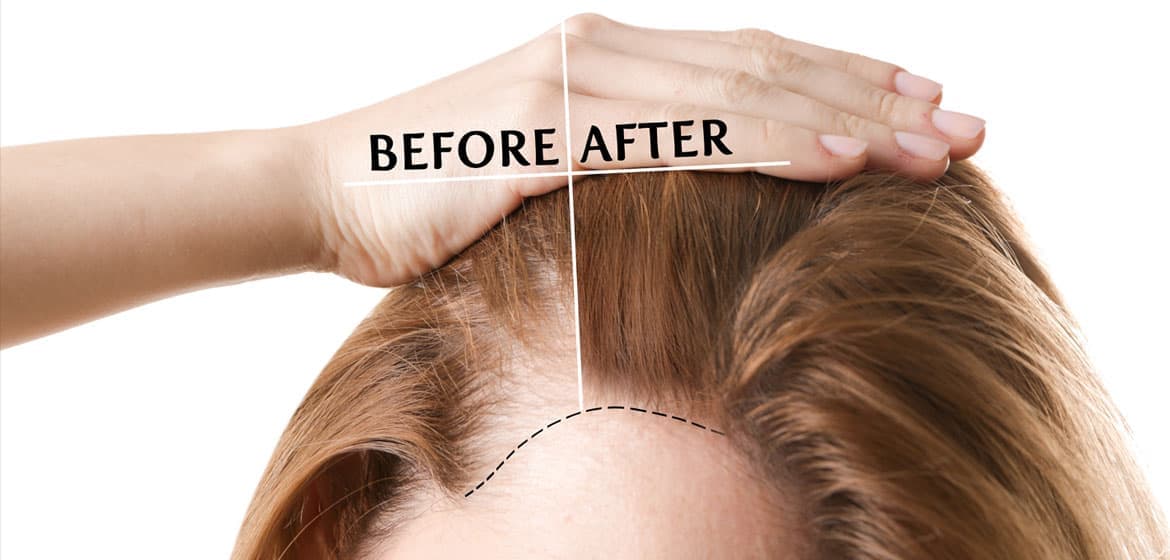 Hair Transplant Turkey: Expert Care from Start to Finish