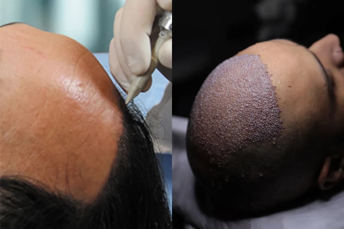 Hair Transplant – Best Practices for Long-Lasting Results
